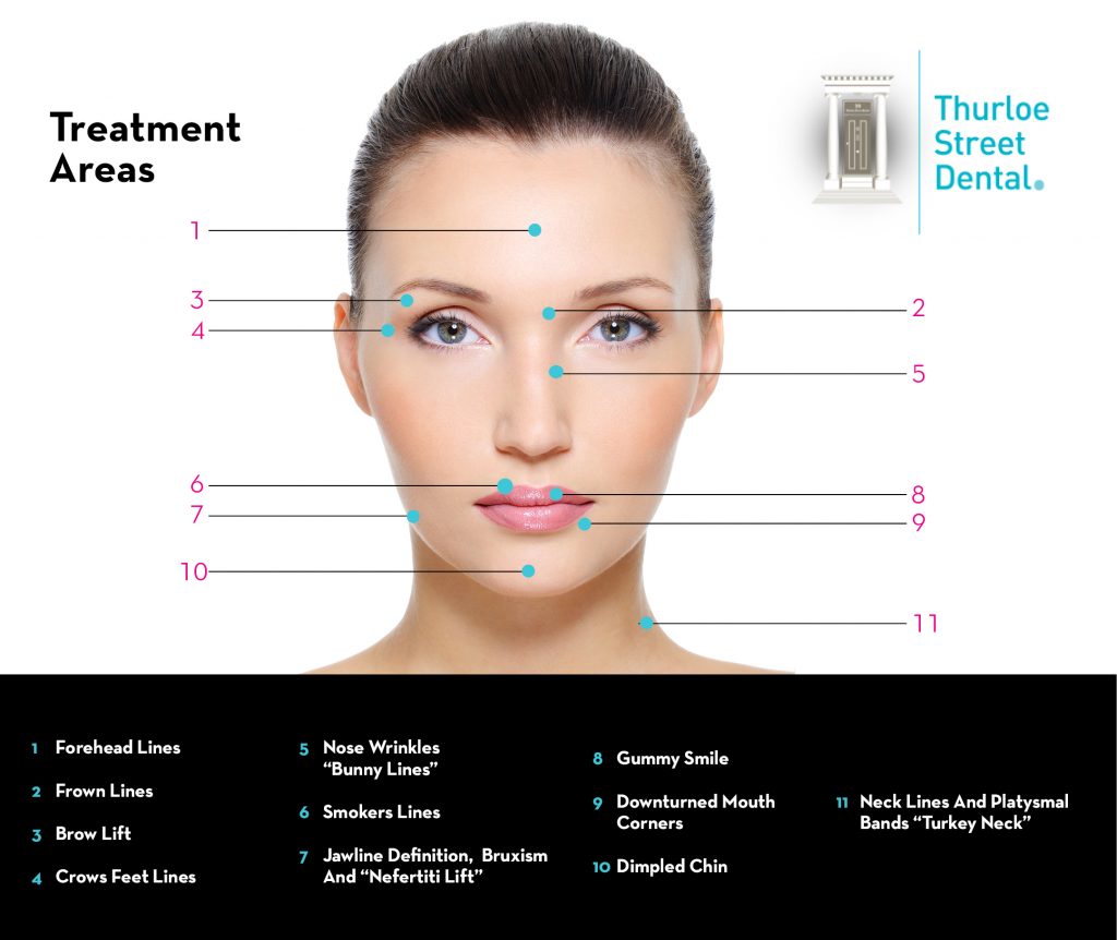 Botox/Anti-Wrinkle Injections South Kensington