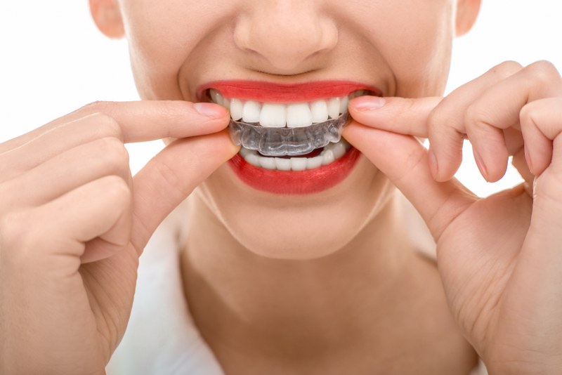 Invisalign aligner