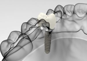 Dental Implants in South Kensington, London