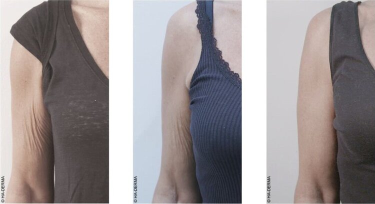 Profhilo treatment London - before and after photos of arms