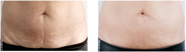 Profhilo before and after photo of abdomen