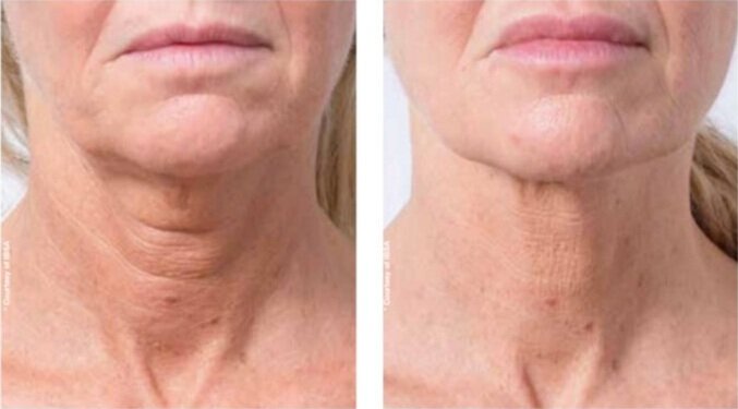 Profhilo before and after results on neck