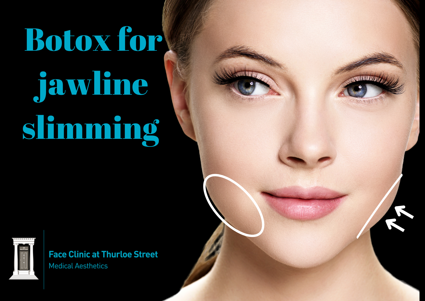 Botox to slim jawline masseter muscle