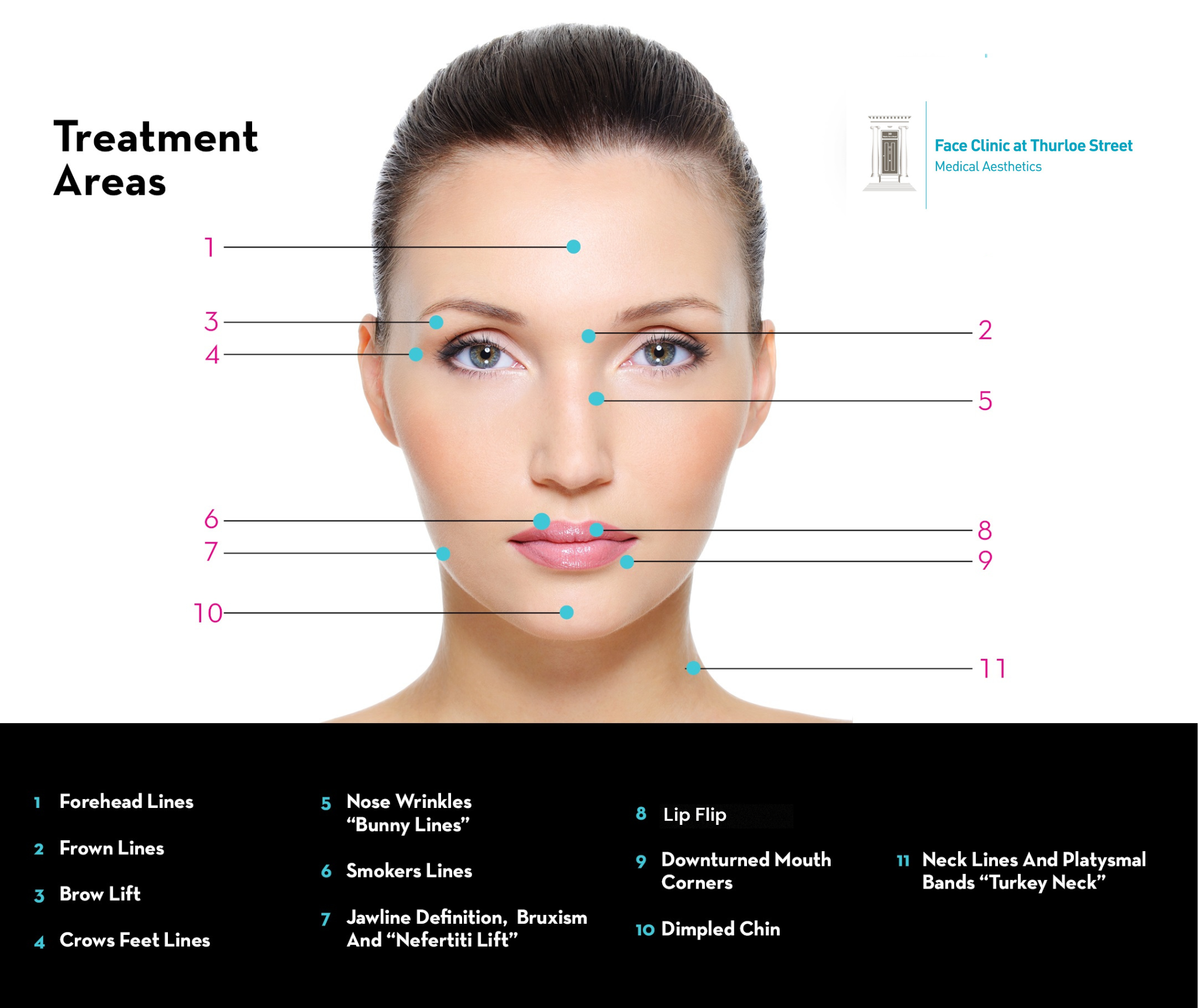 areas of face where botox can be used