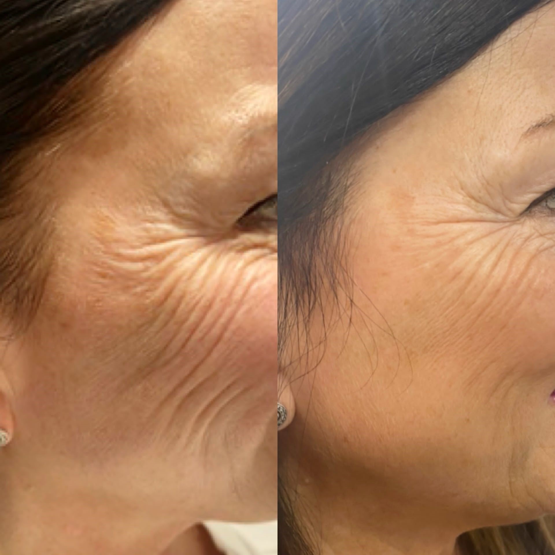 Photo showing before and after result of Profhilo treatment on face in South Kensington 